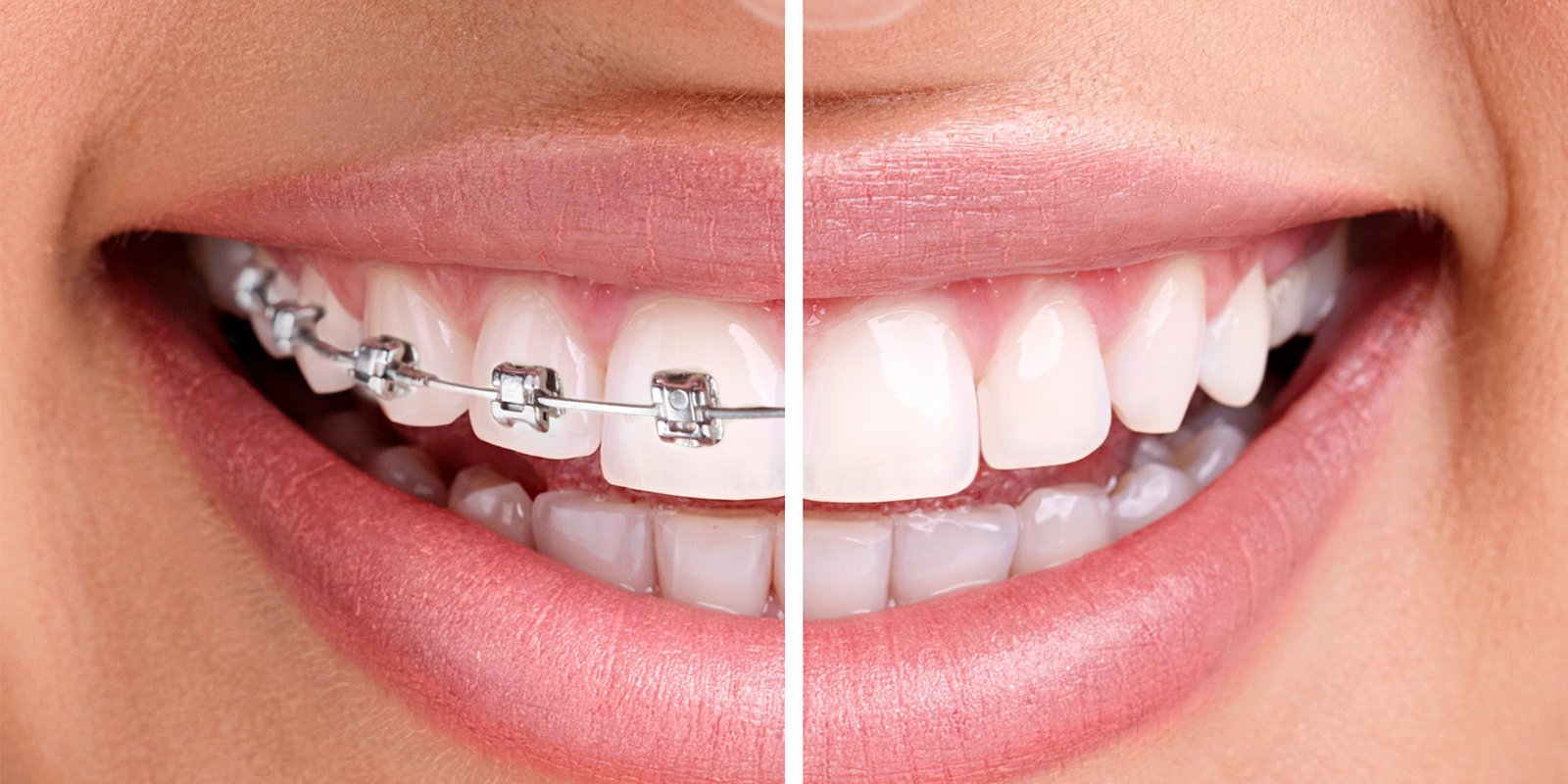 Smile transformation with orthodontic braces