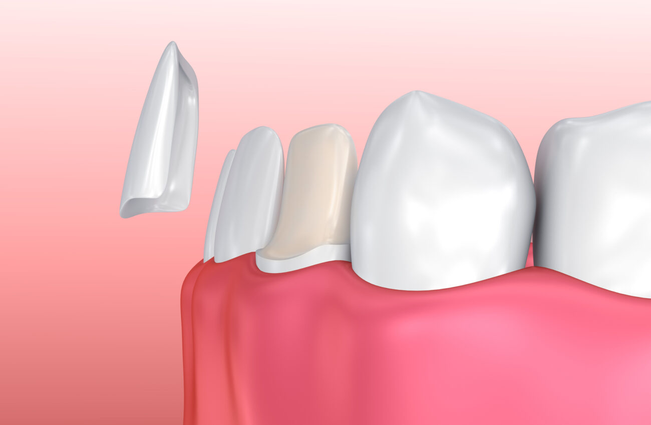 Dental veneer placement illustration