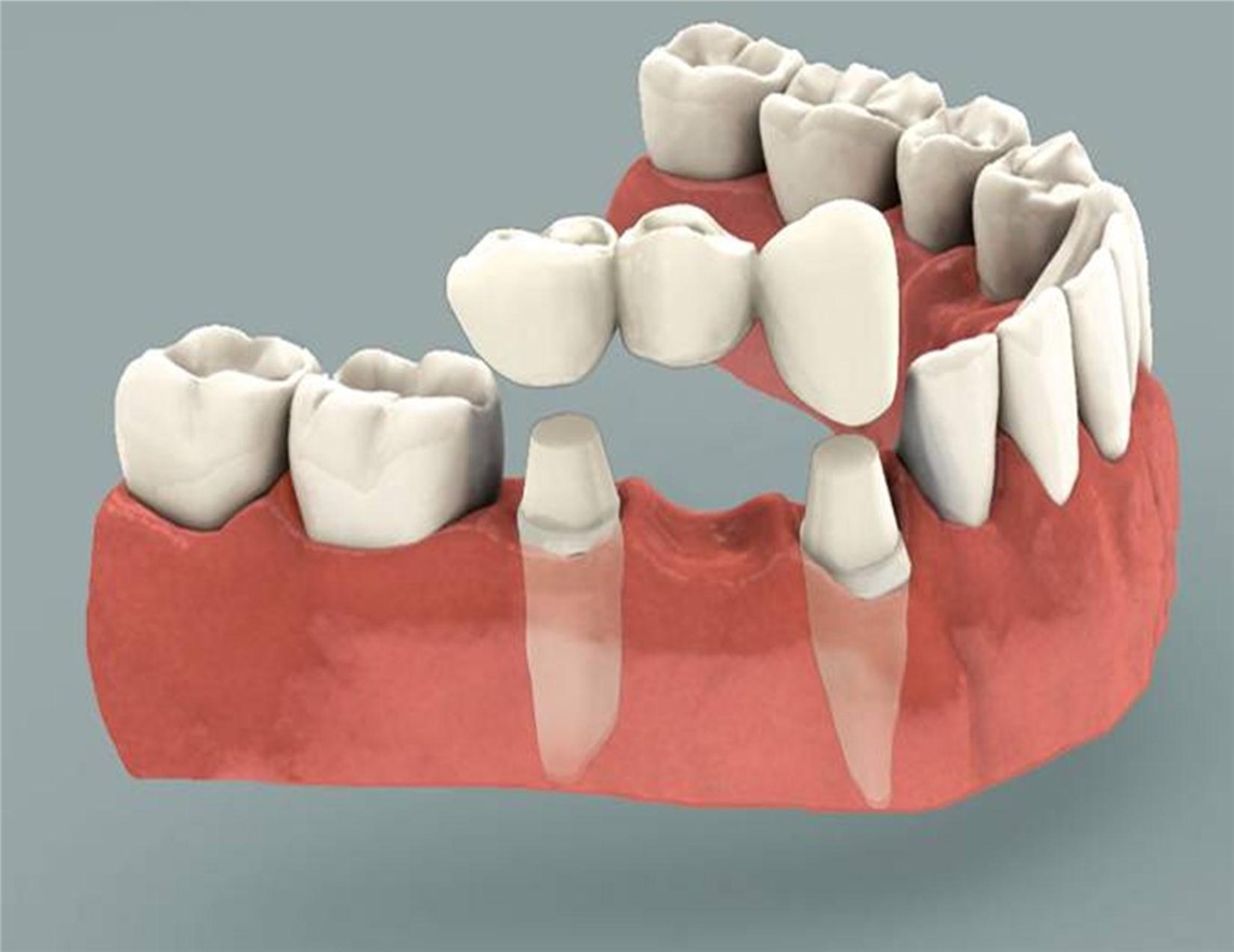 Dental prosthetic rehabilitation