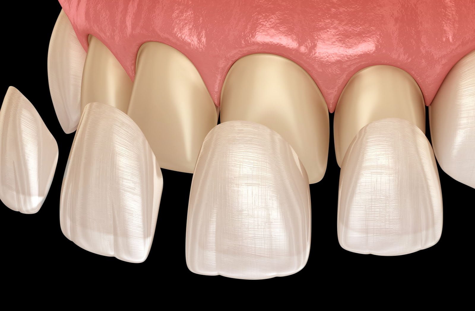 Dental veneers treatment