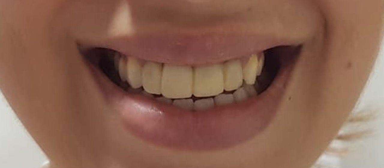 After treatment - Clinical Case 2