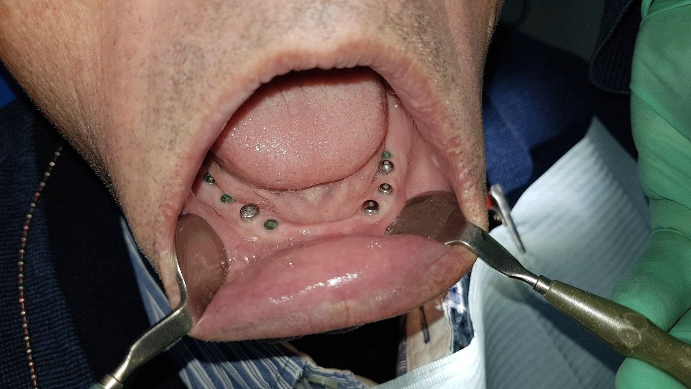 After treatment - Clinical Case 1