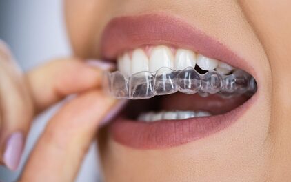 Clear aligners orthodontic treatment