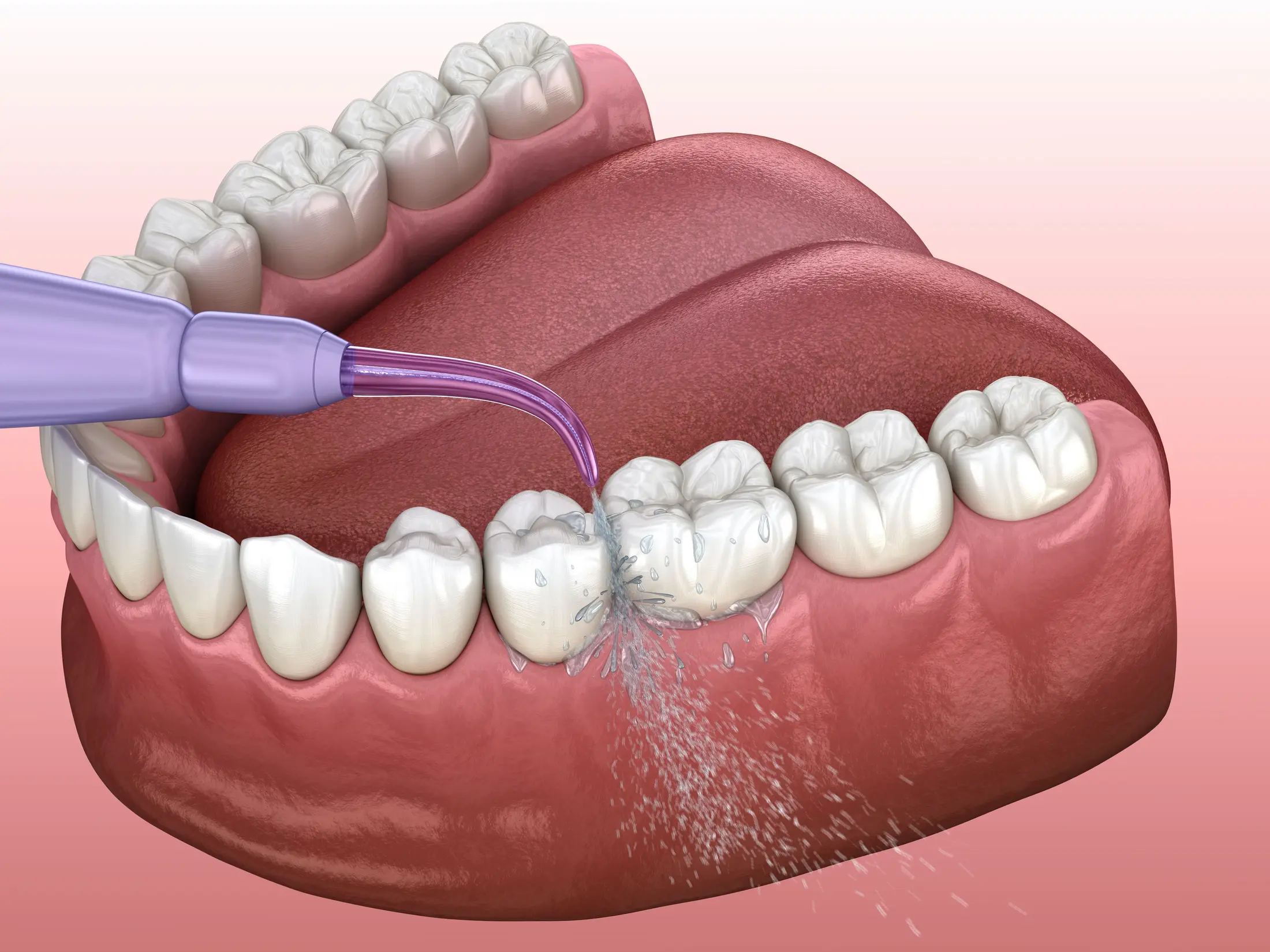 Professional dental cleaning and scaling treatment