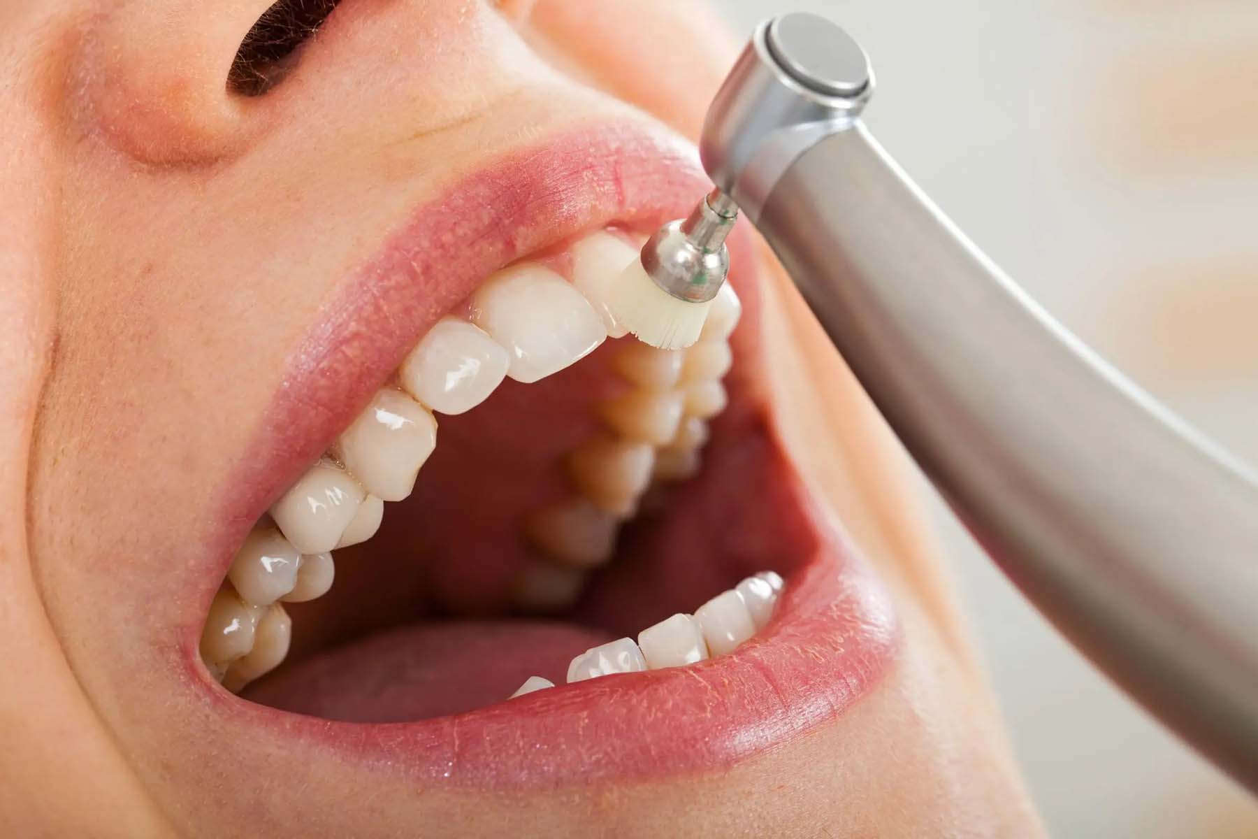 Health benefits of regular professional dental cleaning